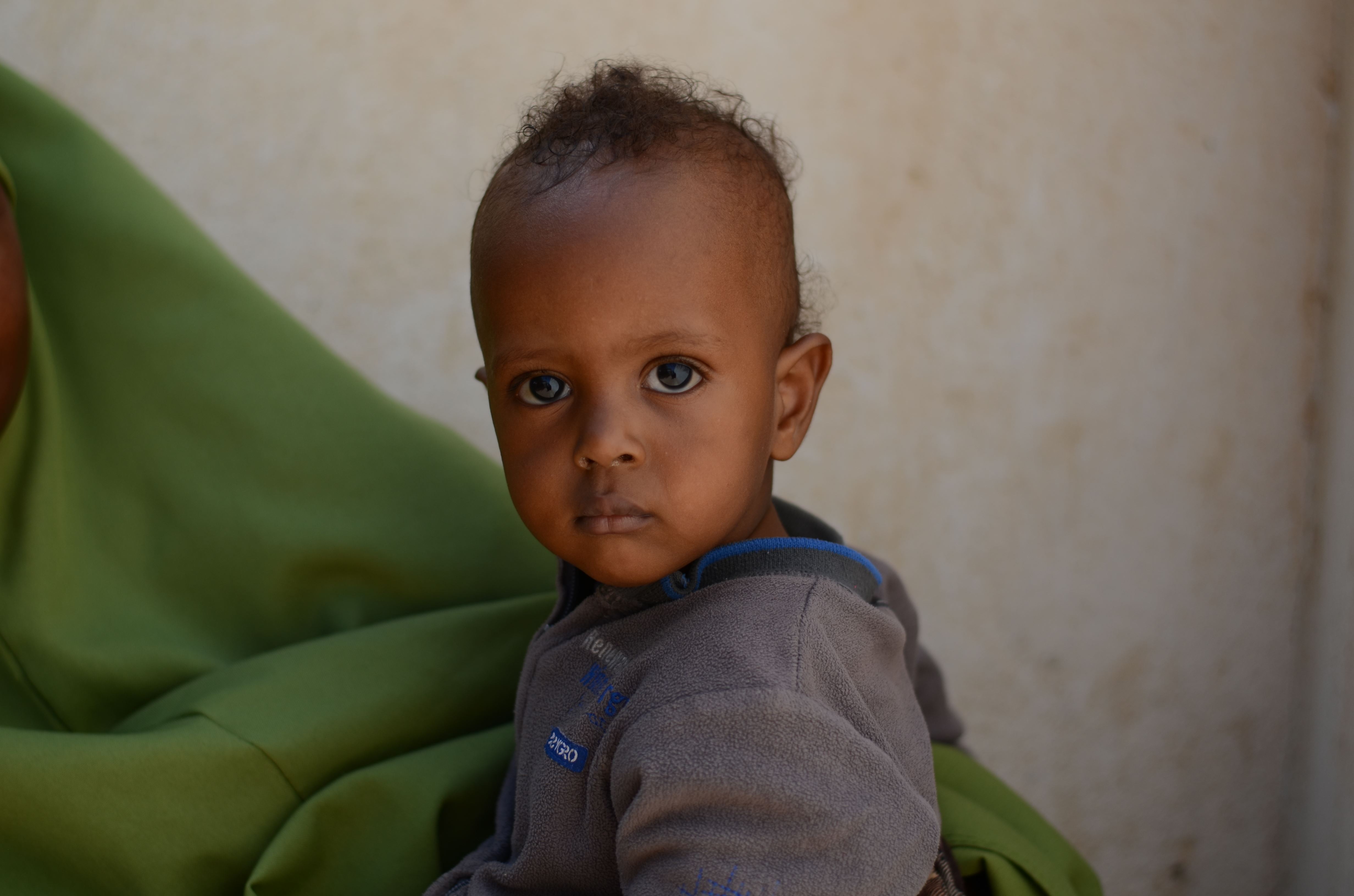 Hussein, de 10 meses, solía estar desnutrido.